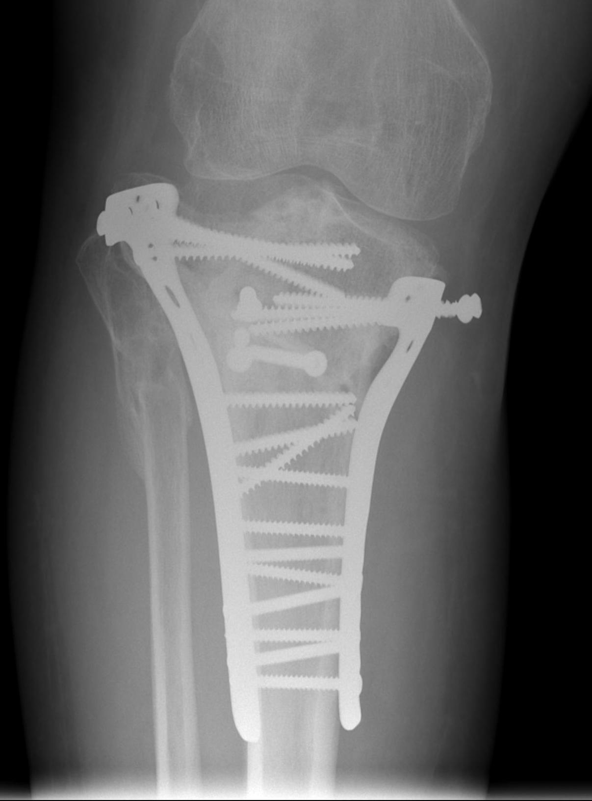 Tibial Plateau Collapse Malunion 